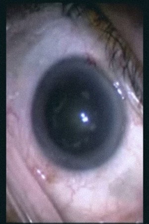Botched Eyeball Operation